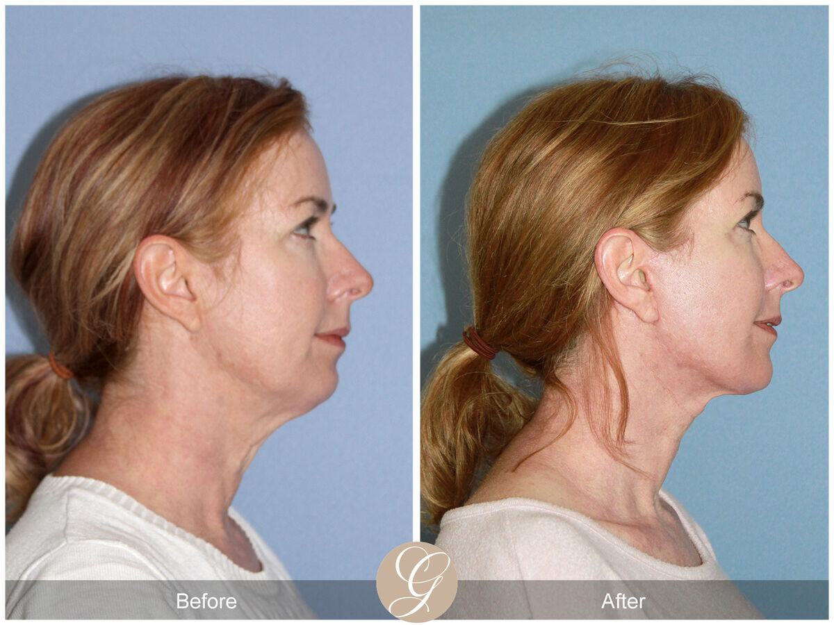 Facelift Forties Before & After Photo