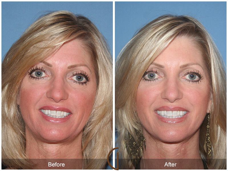 Facelift Forties Before & After Photo