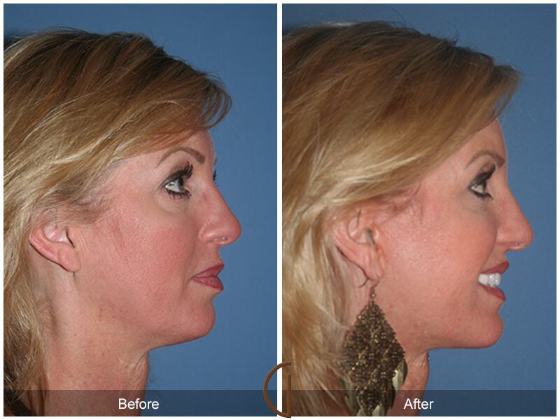 Facelift Forties Before & After Photo