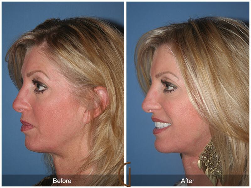 Facelift Forties Before & After Photo