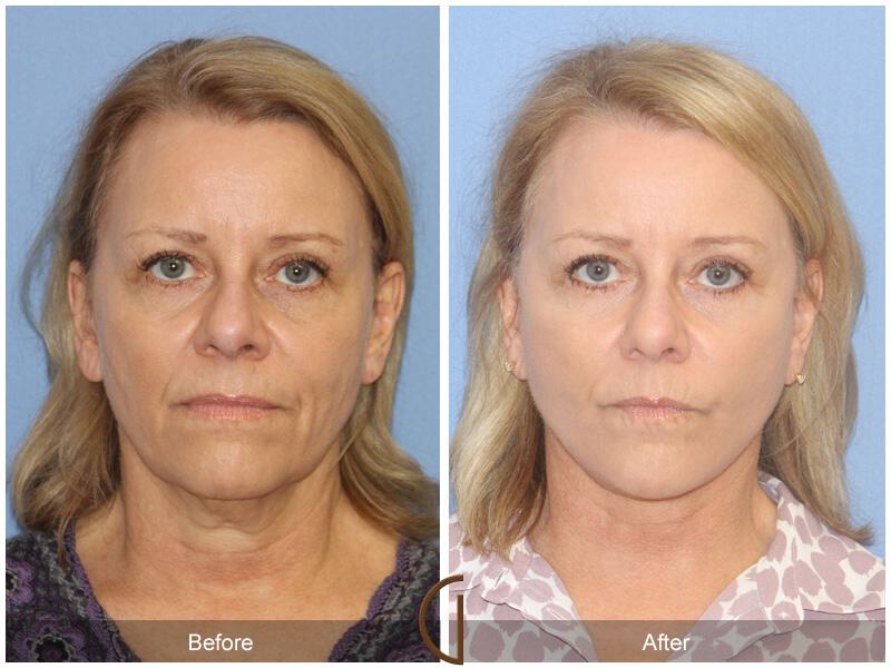 Facelift Forties Before & After Photo