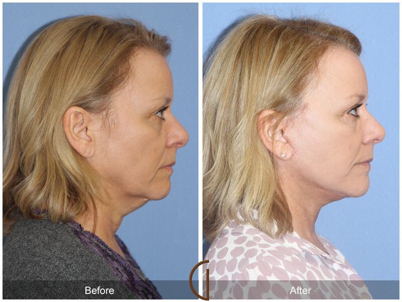 Facelift Forties Before & After Photo