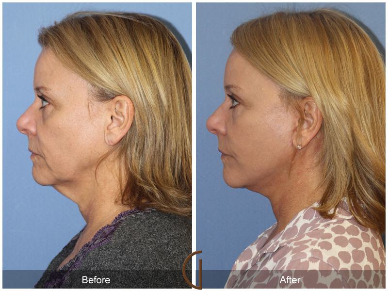 Facelift Forties Before & After Photo