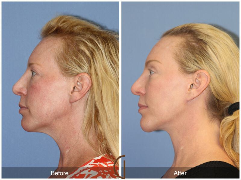 Facelift Forties Before & After Photo