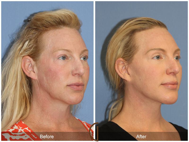 Facelift Forties Before & After Photo