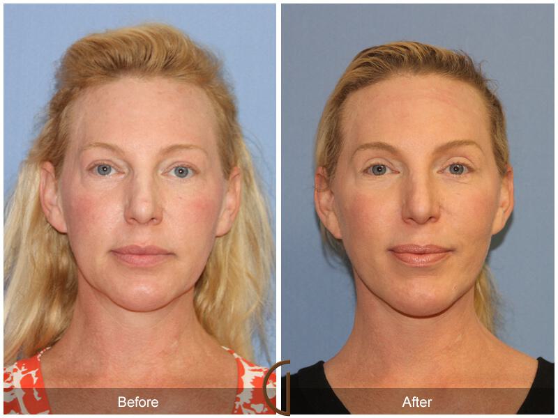 Facelift Forties Before & After Photo