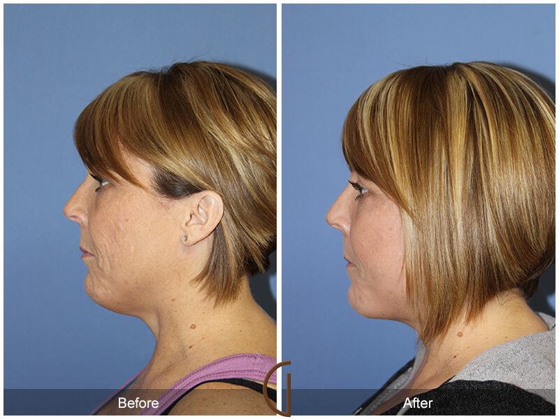 Facelift Forties Before & After Photo