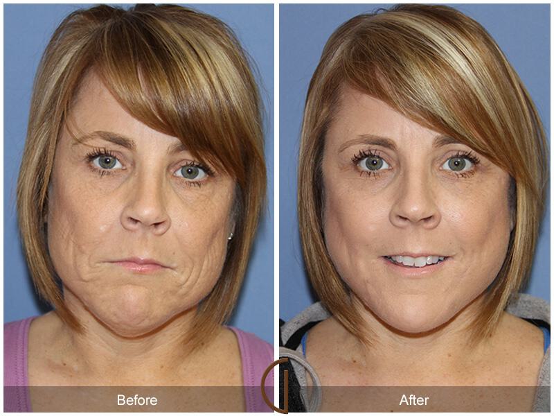 Facelift Forties Before & After Photo