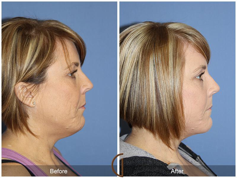 Facelift Forties Before & After Photo