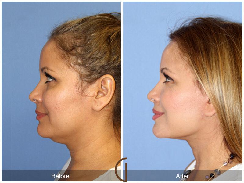 Facelift Forties Before & After Photo