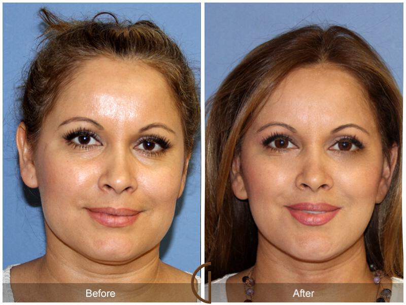 Facelift Forties Before & After Photo