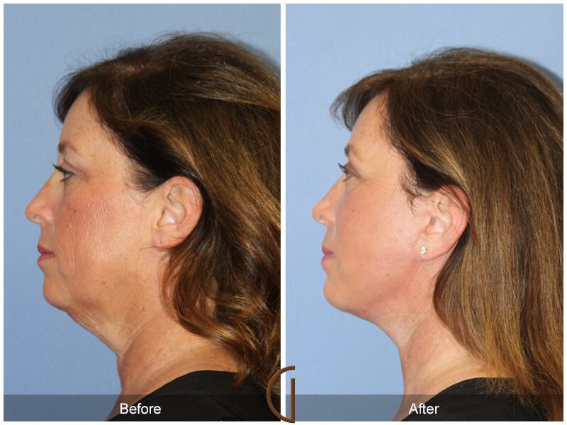 Facelift Fifties Before & After Photo