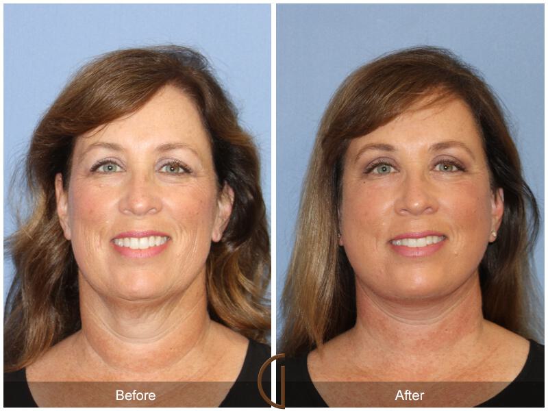 Facelift Fifties Before & After Photo