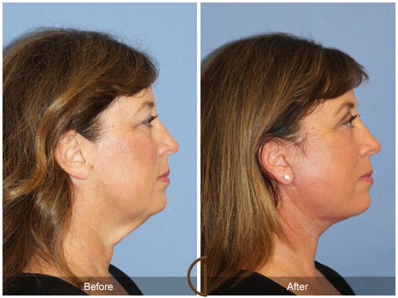 Facelift Fifties Before & After Photo