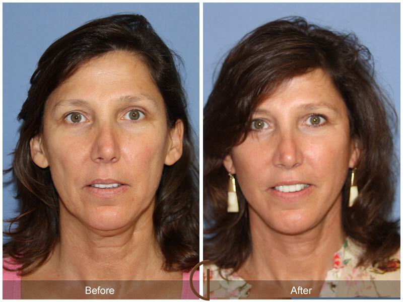 Facelift Fifties Before & After Photo