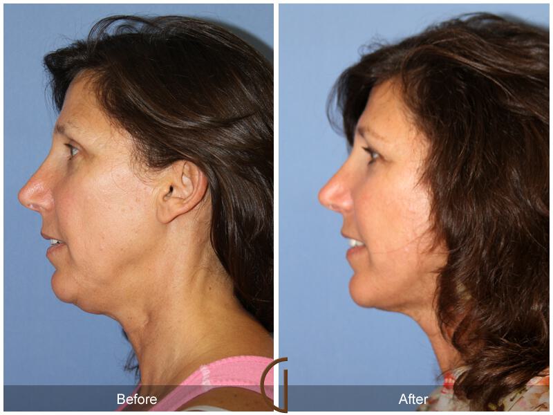 Facelift Fifties Before & After Photo