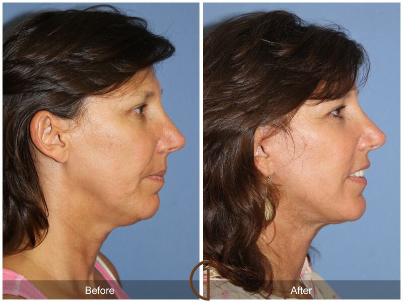 Facelift Fifties Before & After Photo