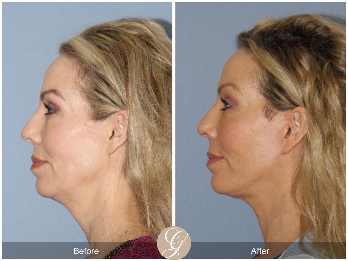 Facelift Fifties Before & After Photo