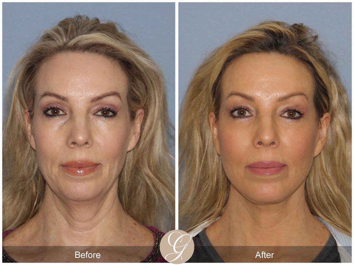 Facelift Fifties Before & After Photo