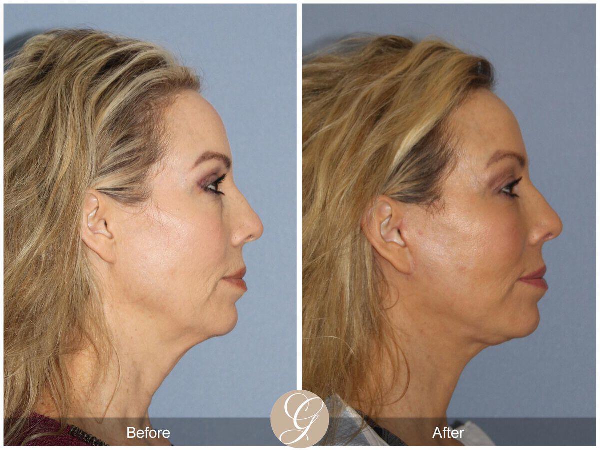 Facelift Fifties Before & After Photo