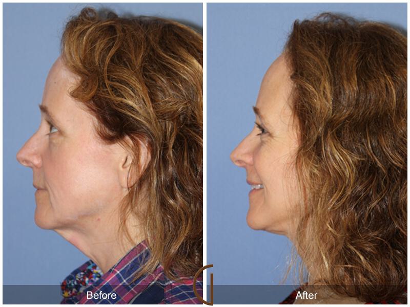 Facelift Fifties Before & After Photo