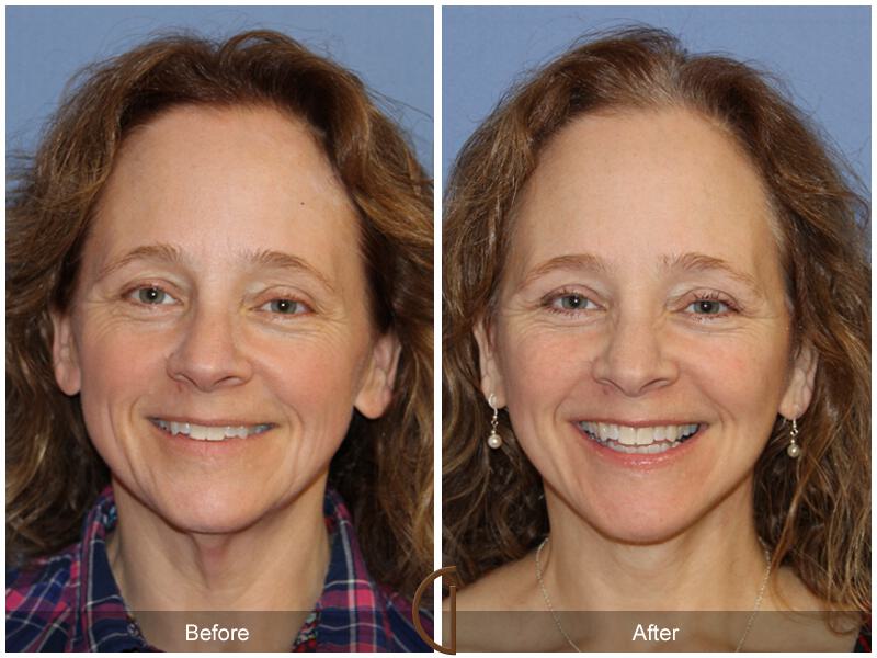 Facelift Fifties Before & After Photo