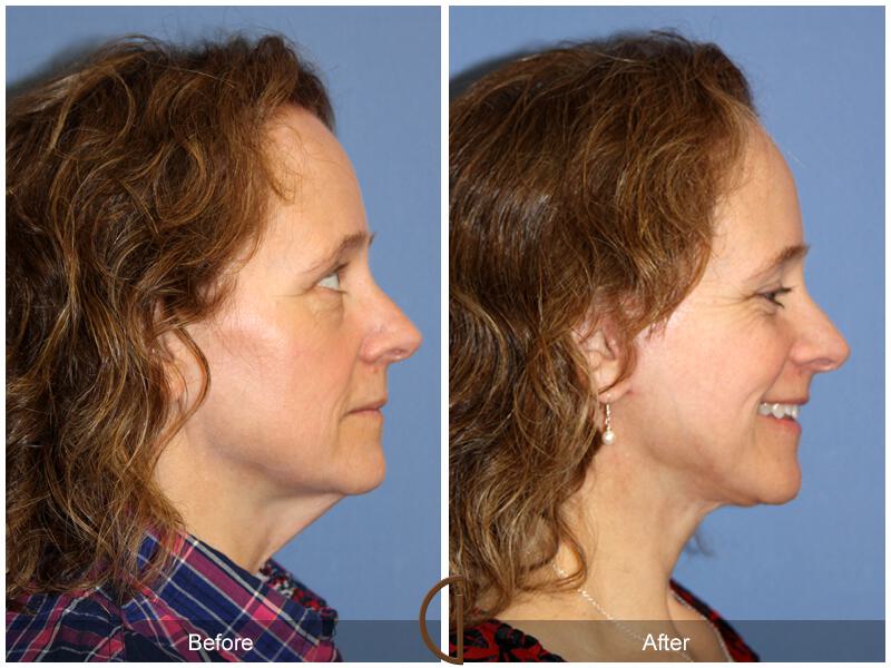 Facelift Fifties Before & After Photo