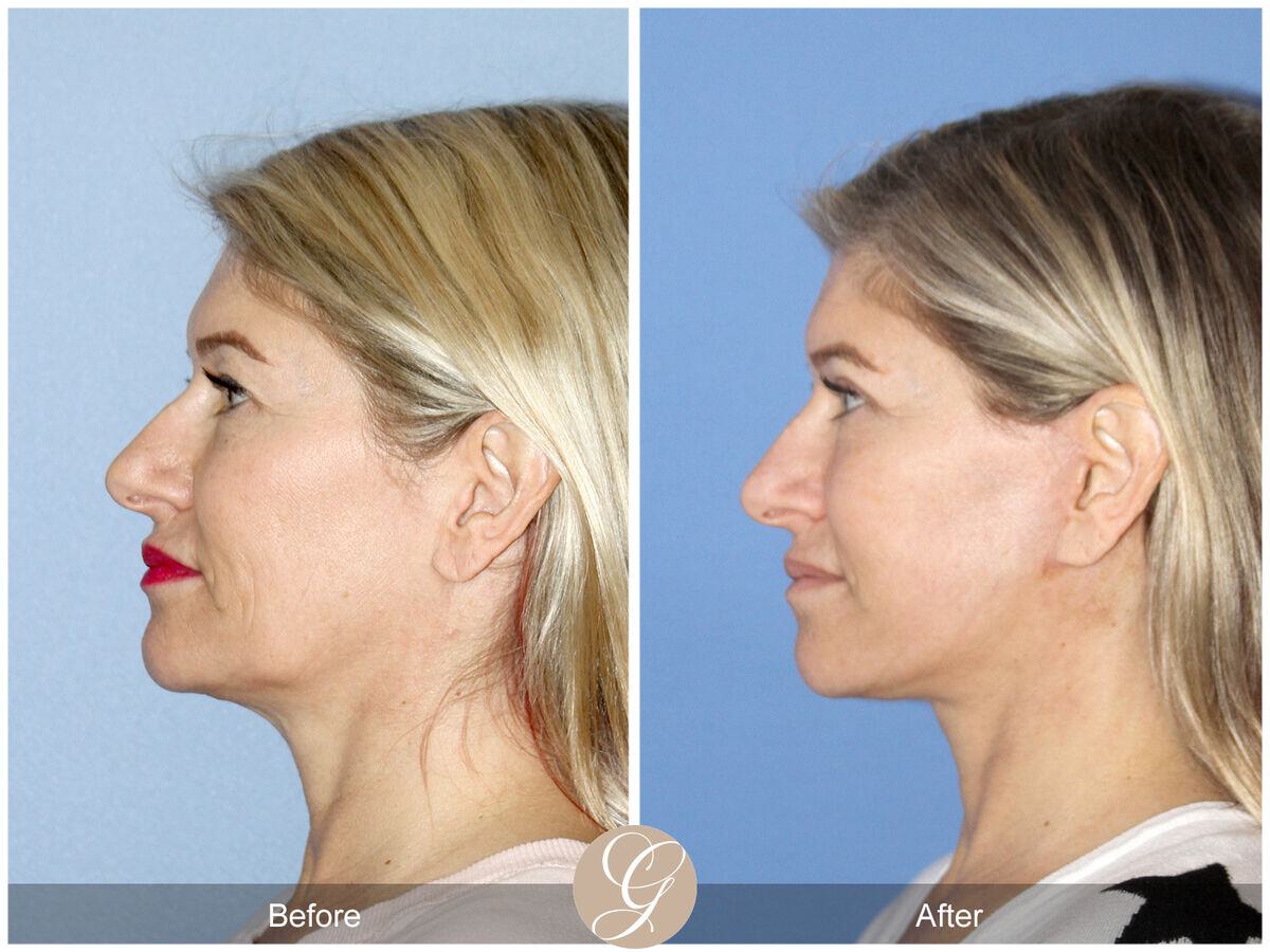 Facelift Fifties Before & After Photo