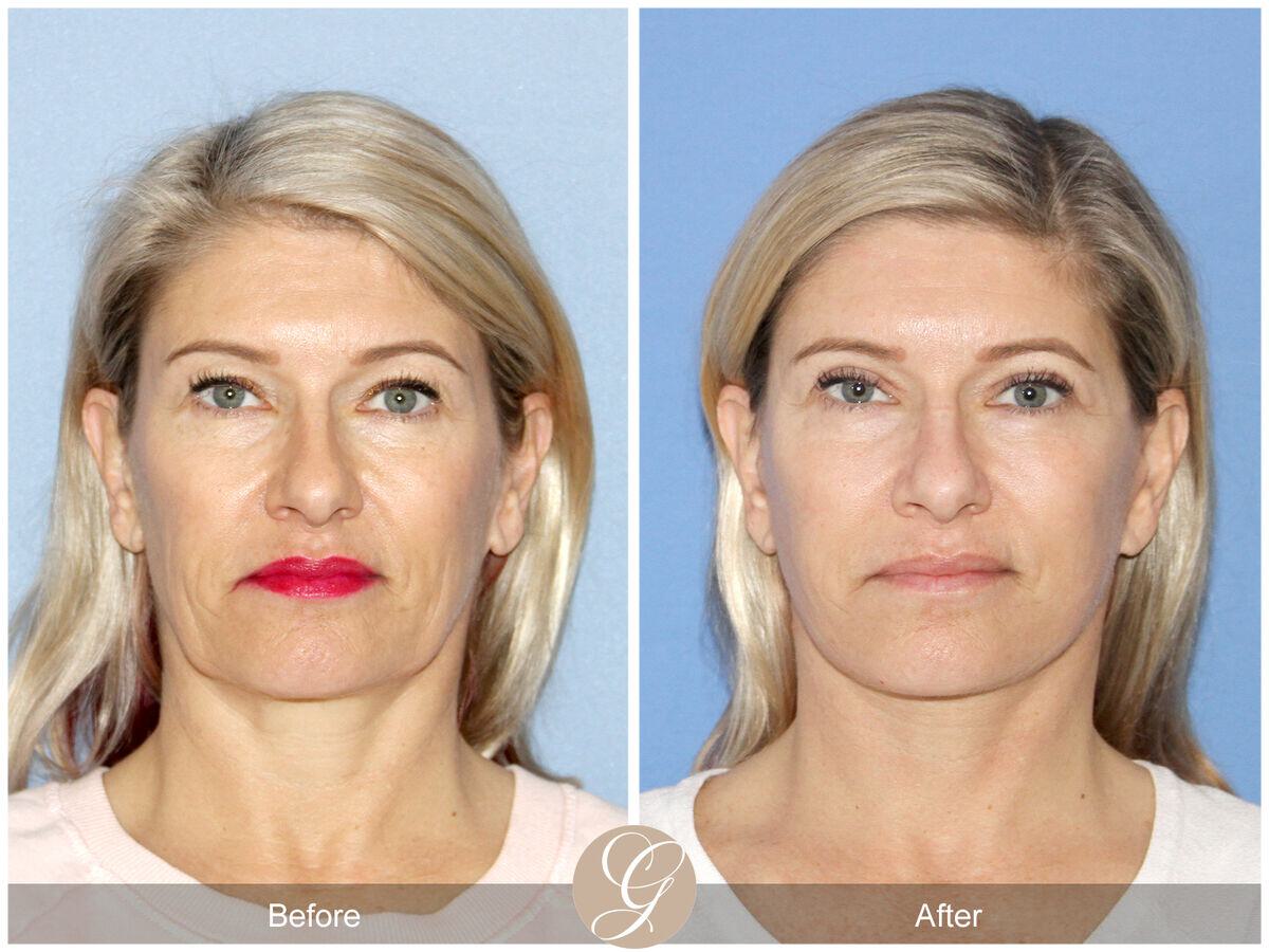 Facelift Fifties Before & After Photo