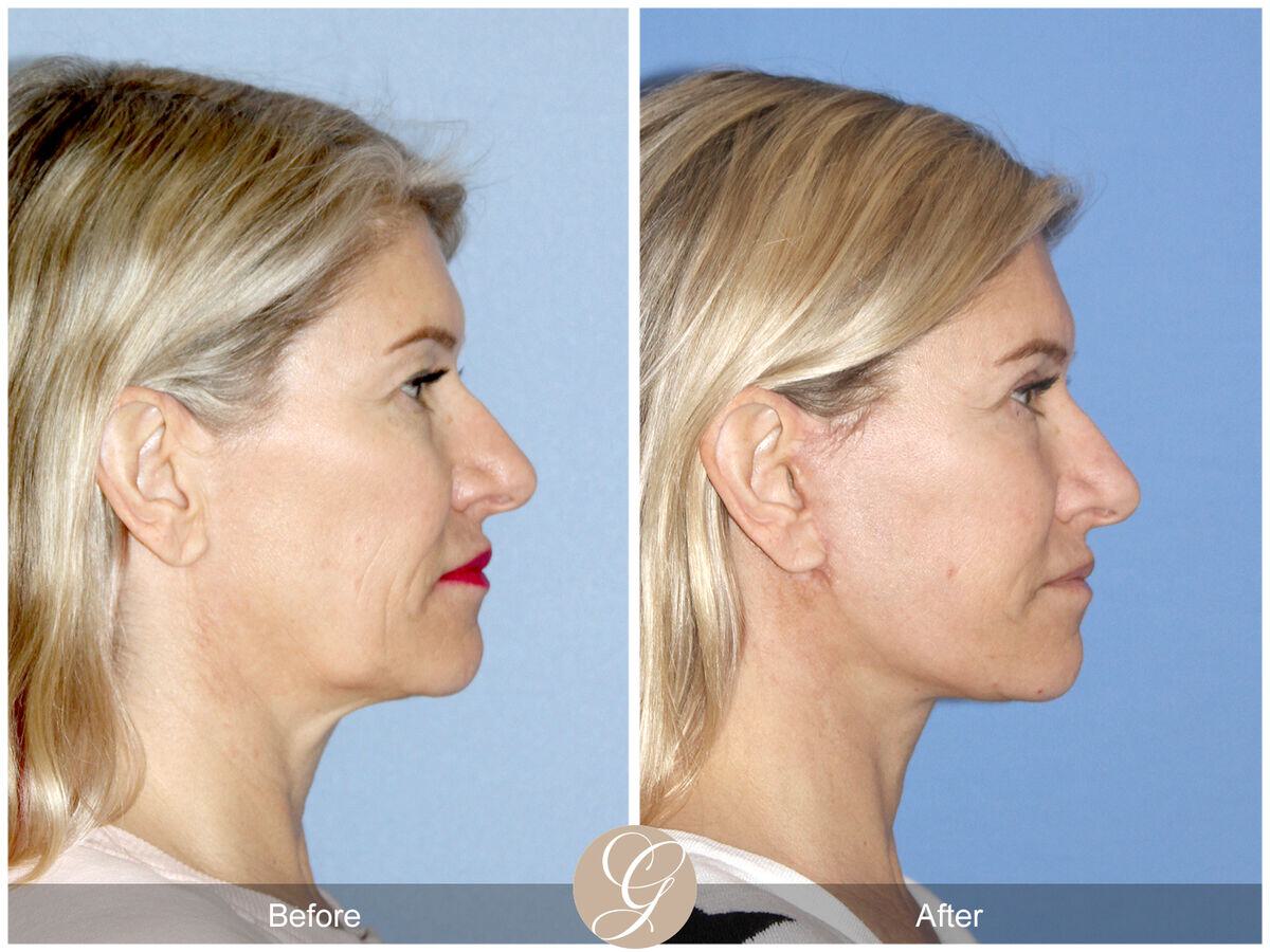 Facelift Fifties Before & After Photo