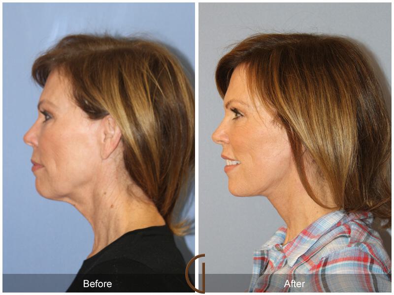 Facelift Fifties Before & After Photo