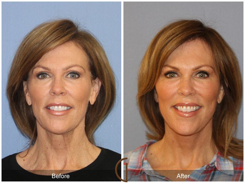 Facelift Fifties Before & After Photo