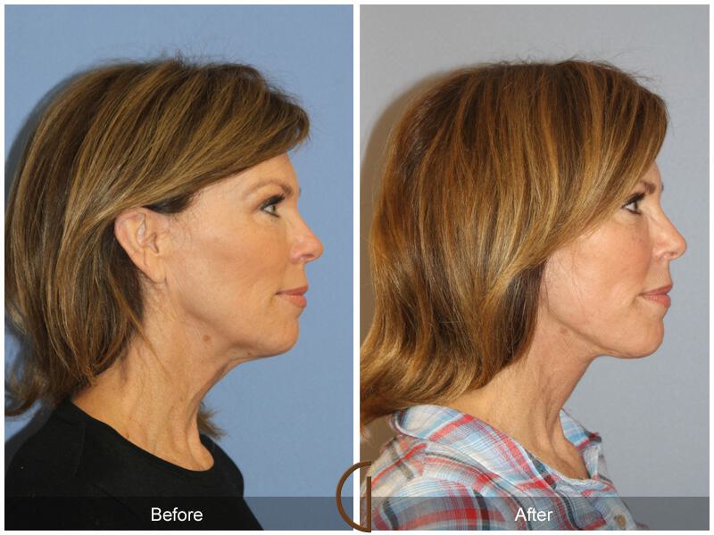 Facelift Fifties Before & After Photo