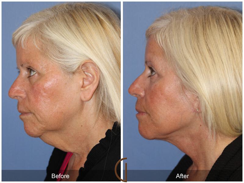 Facelift Fifties Before & After Photo