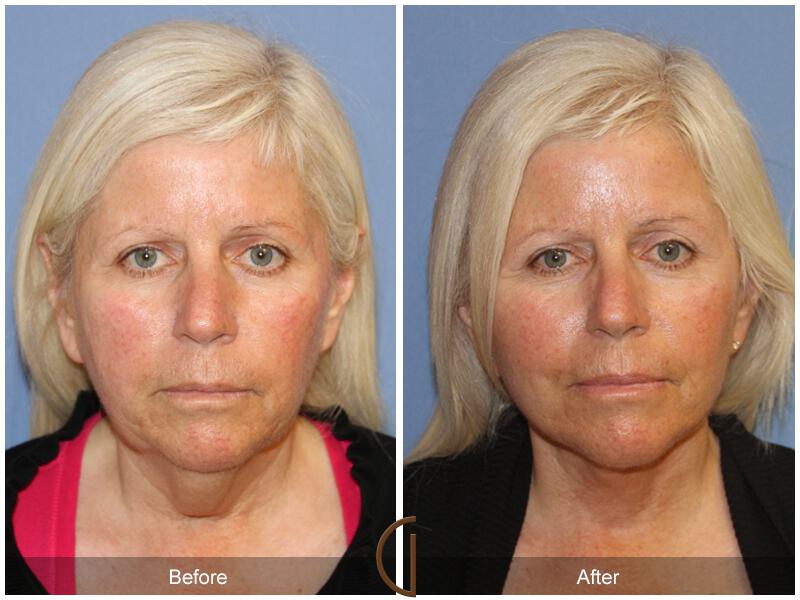 Facelift Fifties Before & After Photo