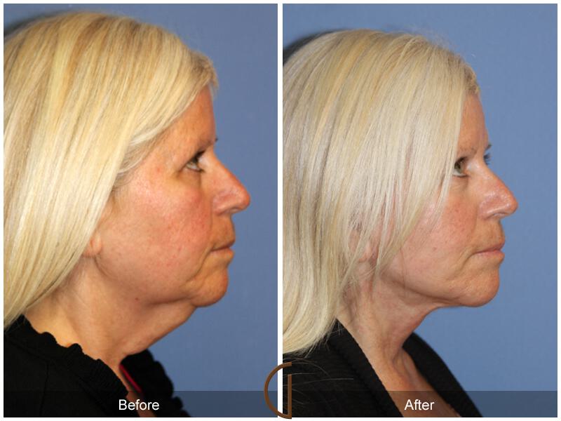 Facelift Fifties Before & After Photo