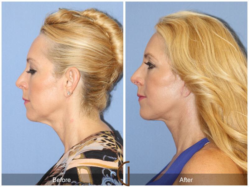 Facelift Fifties Before & After Photo