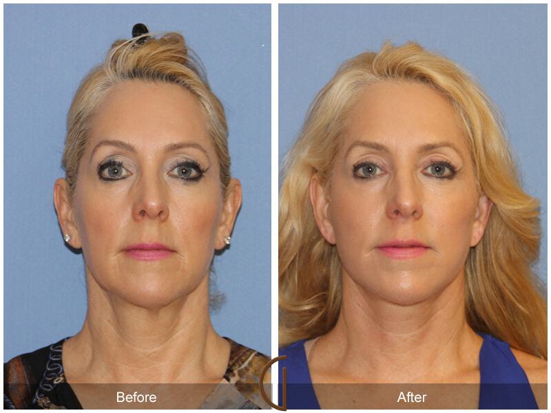 Facelift Fifties Before & After Photo