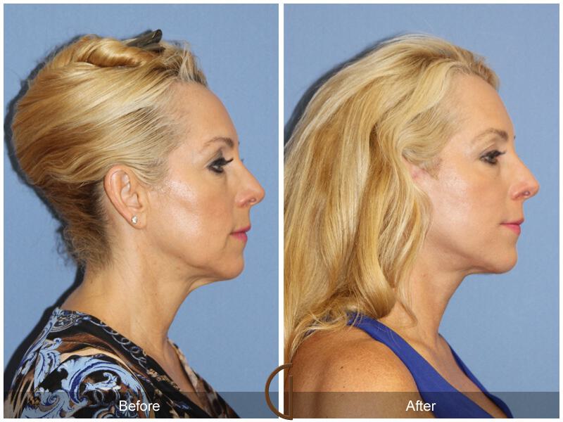 Facelift Fifties Before & After Photo