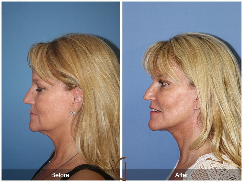 Facelift Fifties Before & After Photo