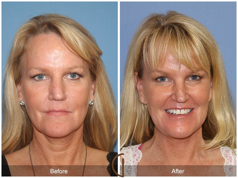 Facelift Fifties Before & After Photo