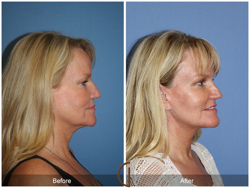 Facelift Fifties Before & After Photo