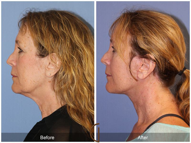 Facelift Fifties Before & After Photo