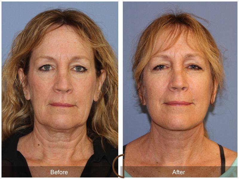 Facelift Fifties Before & After Photo