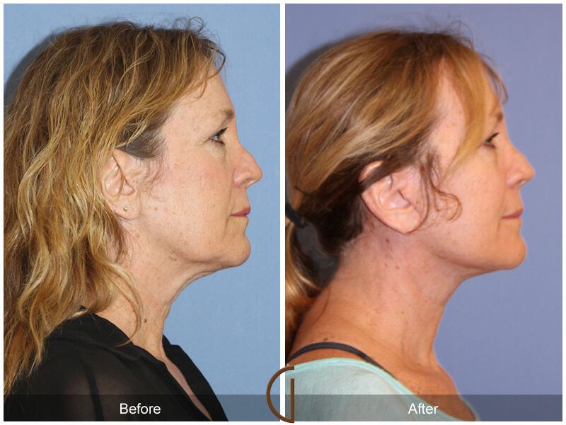 Facelift Fifties Before & After Photo