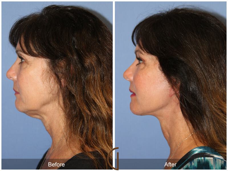 Facelift Fifties Before & After Photo