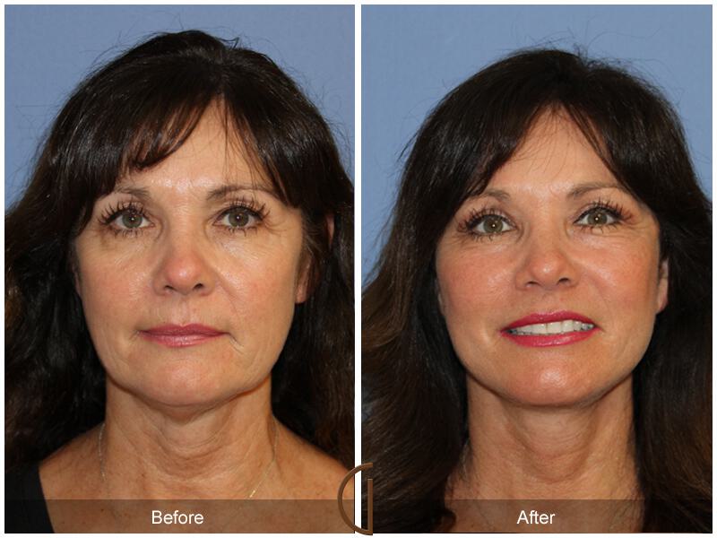 Facelift Fifties Before & After Photo