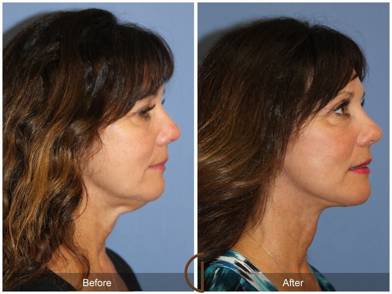 Facelift Fifties Before & After Photo