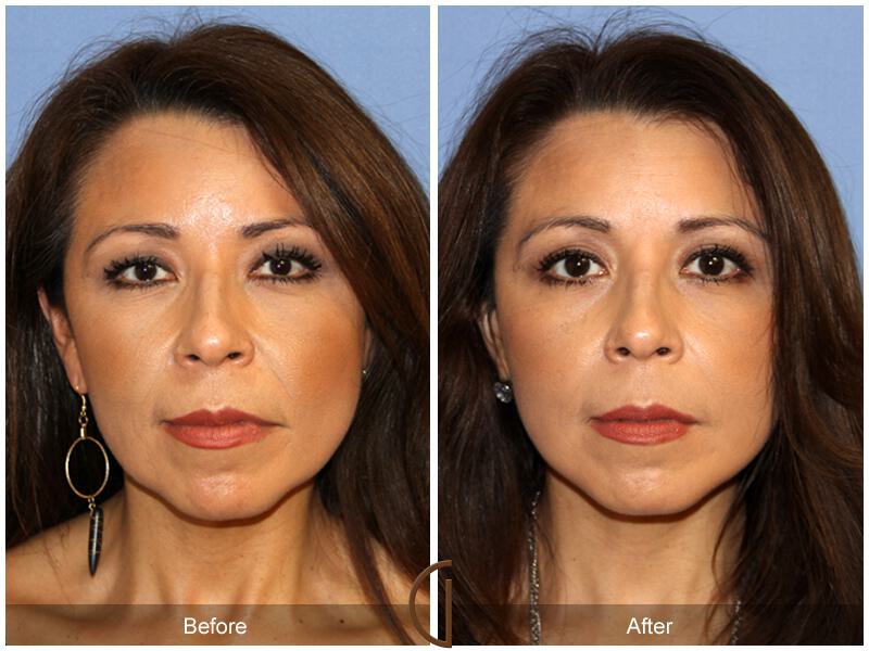 Facelift Fifties Before & After Photo