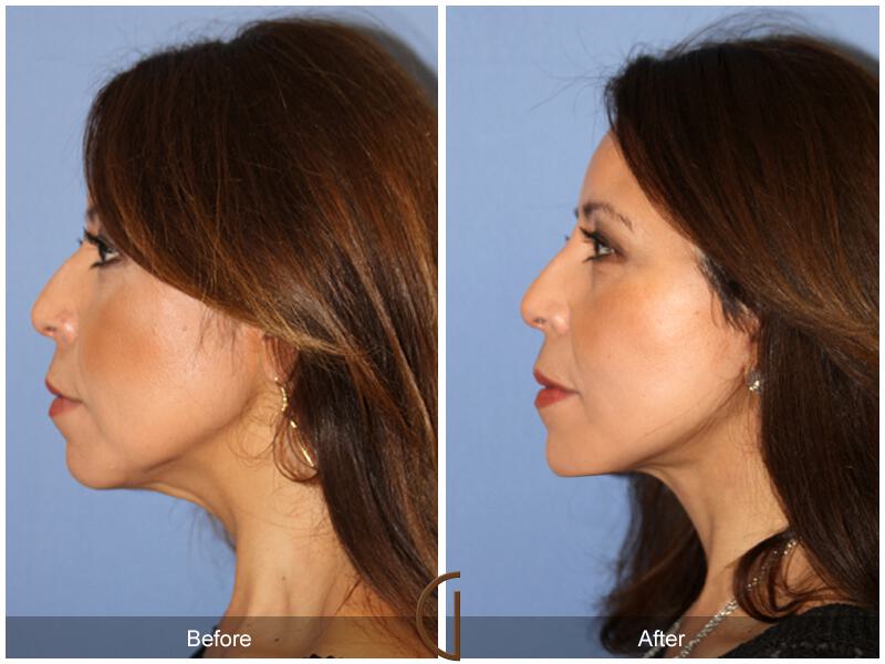 Facelift Fifties Before & After Photo